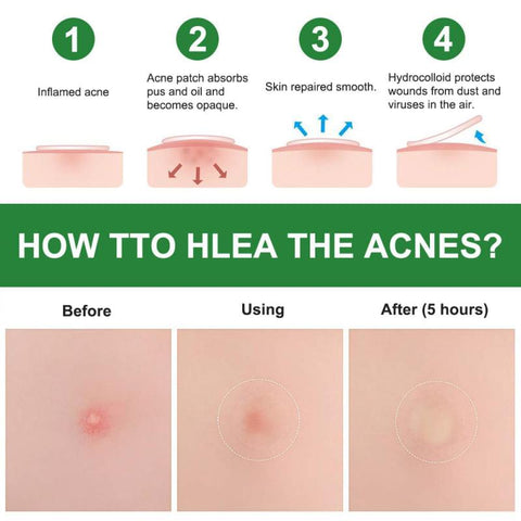 Acne Pimple Patch Skin Care