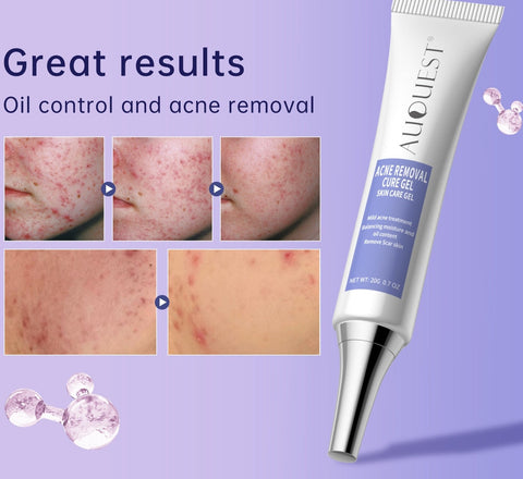 New Herbal Acne Treatment Cream