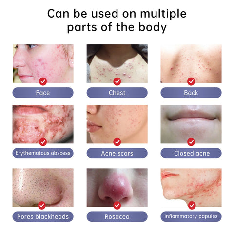 New Herbal Acne Treatment Cream