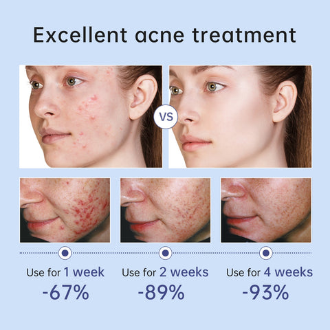 New Herbal Acne Treatment Cream