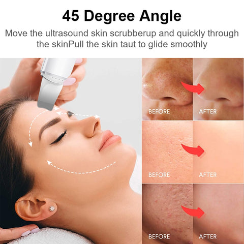Face Spatula Blackhead Remover